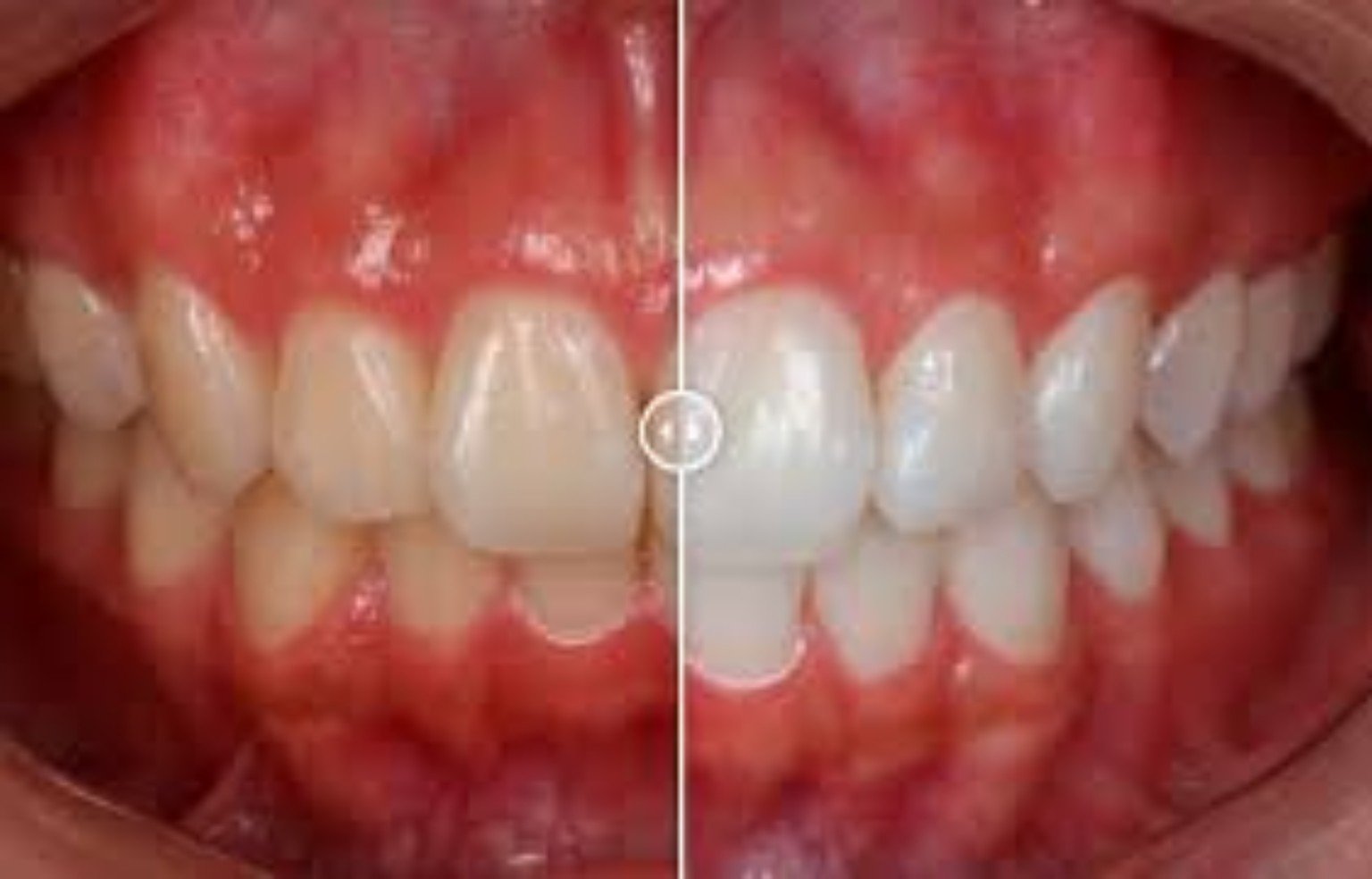 Resultado de clareamento dental antes e depois