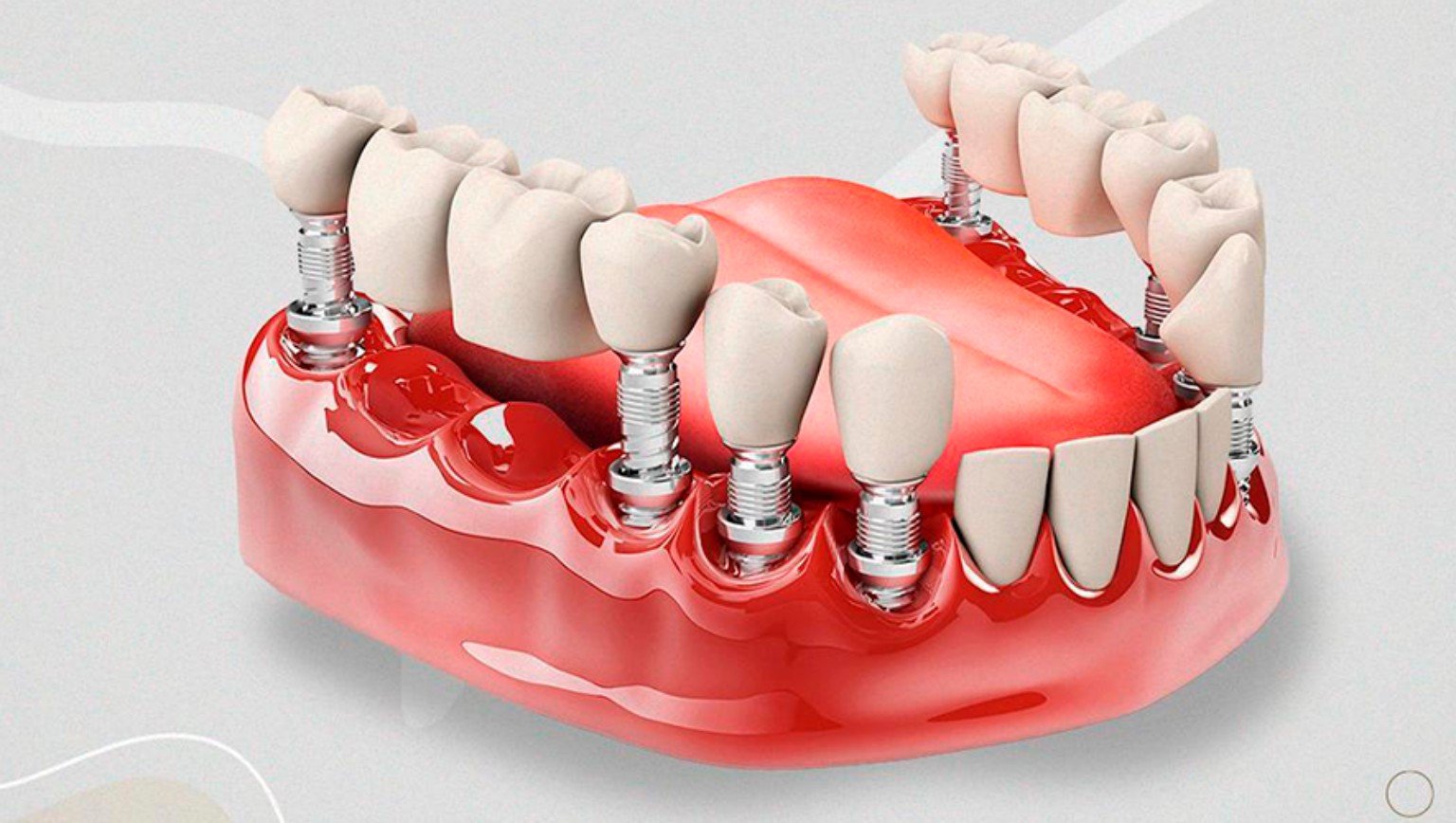 Implantes dentários