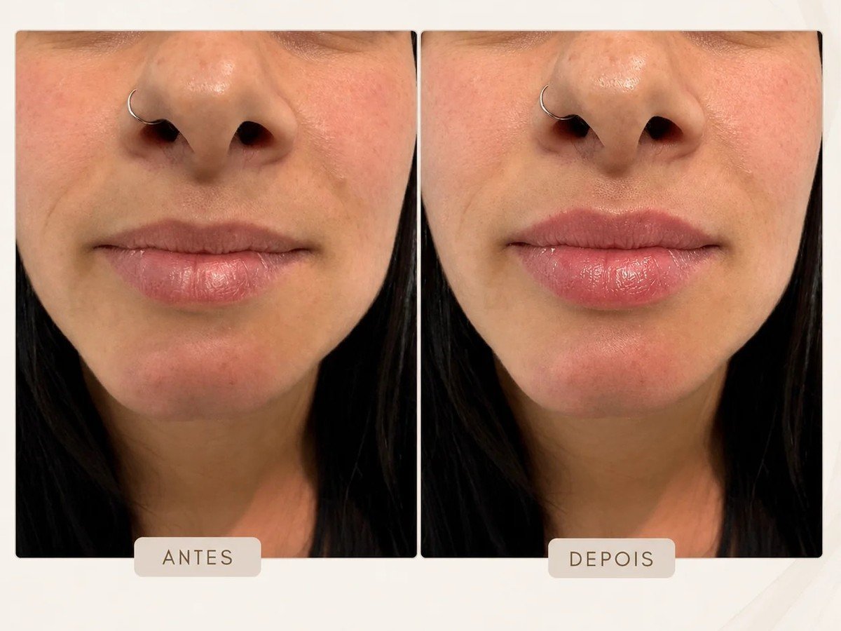 Planejamento de preenchimento labial com naturalidade